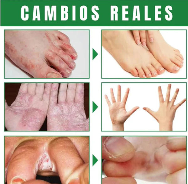 2x1 Spray AntiHongos