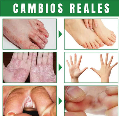 2x1 Spray AntiHongos